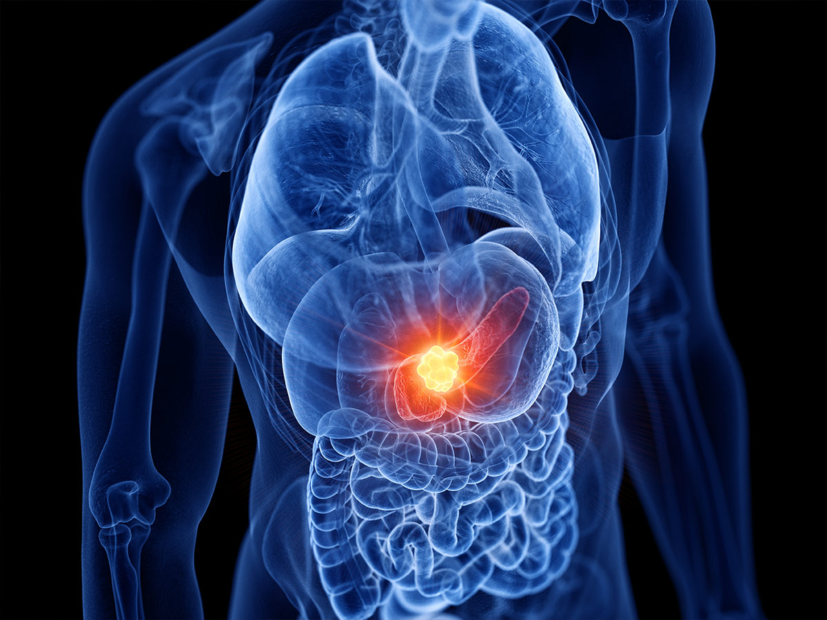 Pancreatitis