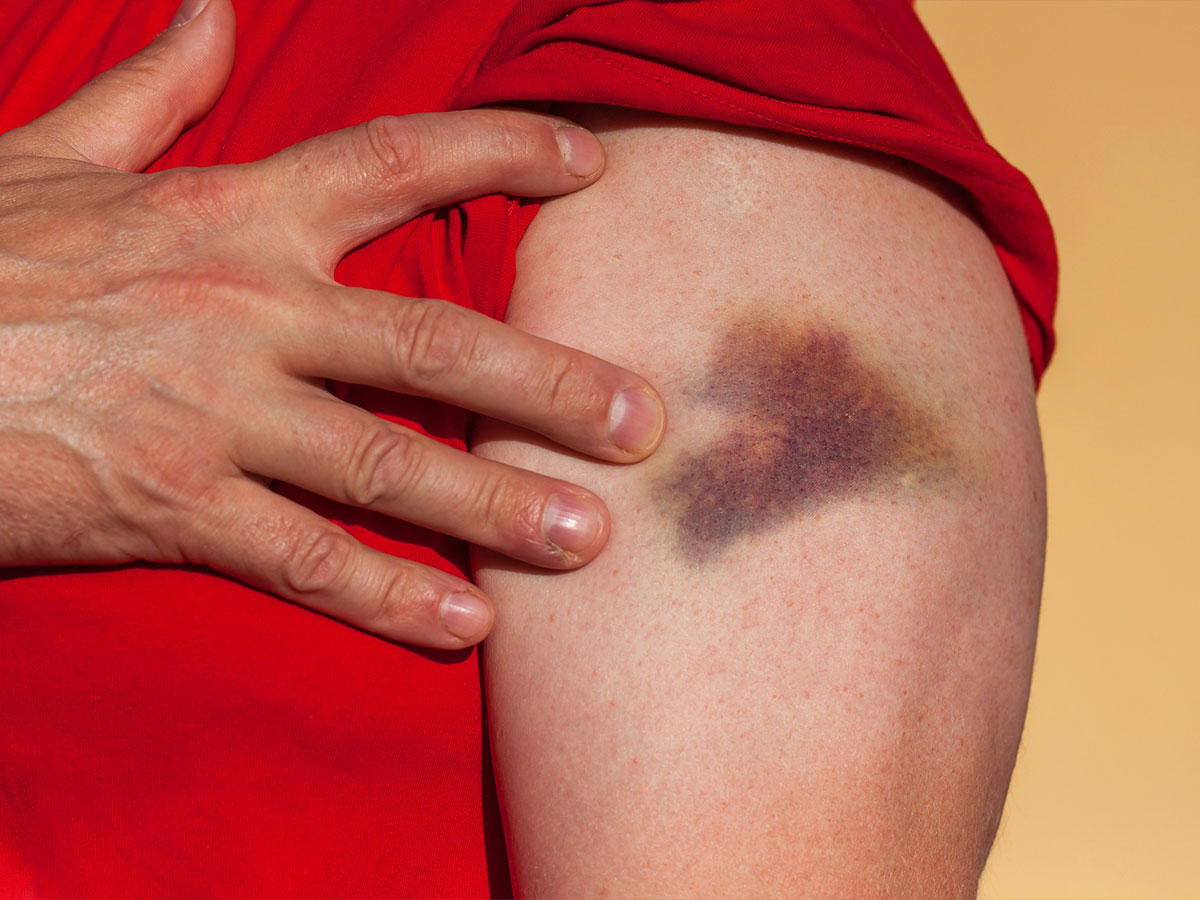 Bruising or Bleeding