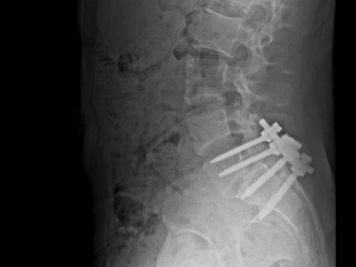 Luigi Mangione had constant spine issues due to spondylolisthesis.