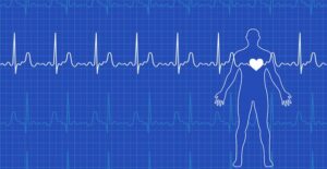 an ECG that may be used to identify the causes of atrial fibrillation