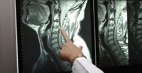 a doctor explaining herniated discs