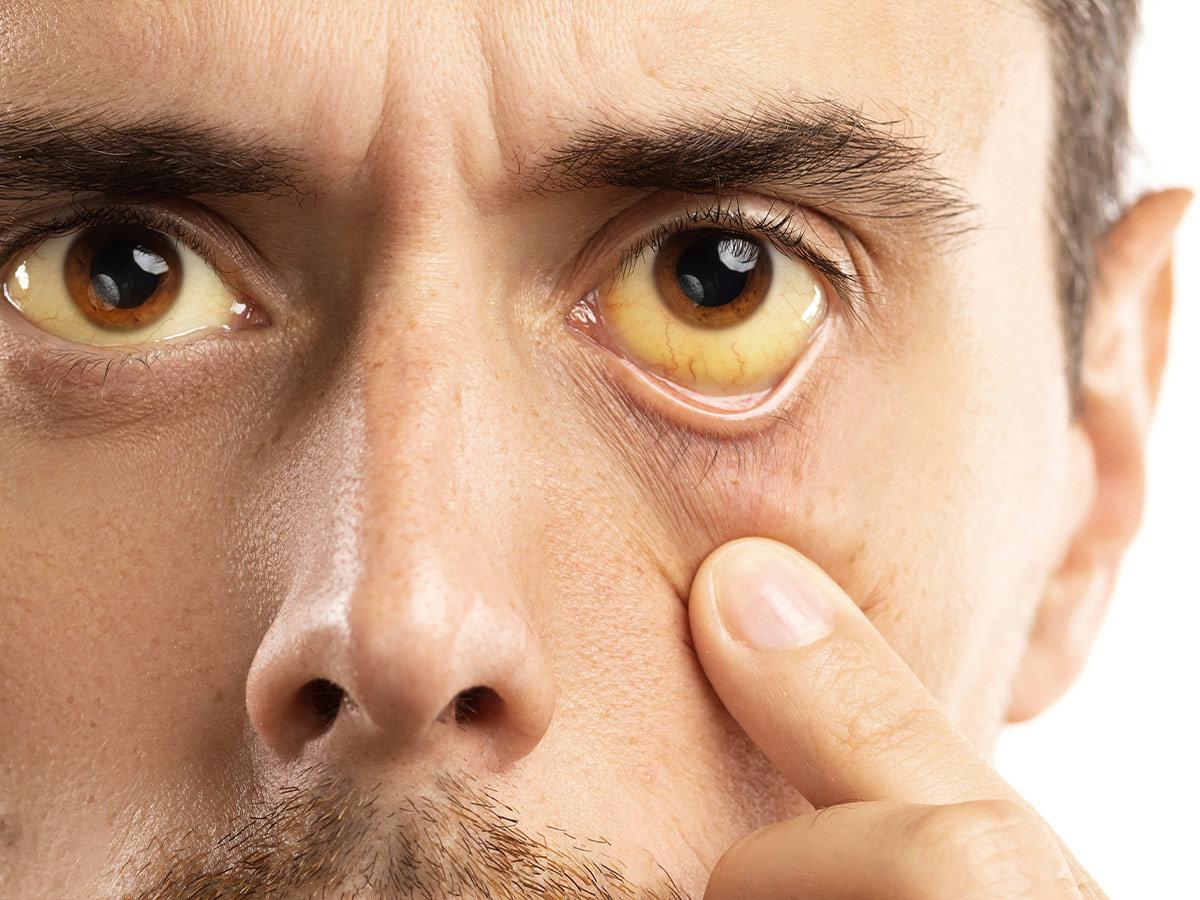 Yellowing of Skin or Eyes