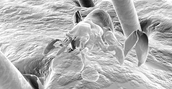 a scalp that's experiencing the symptoms of pubic lice symptoms