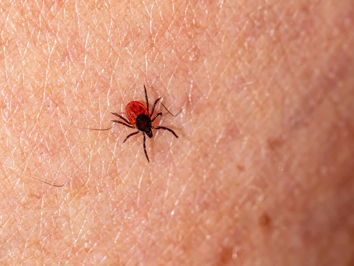 Hard Tick Relapsing Fever