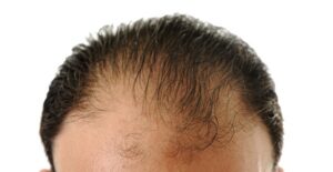 a man who is wondering what causes baldness