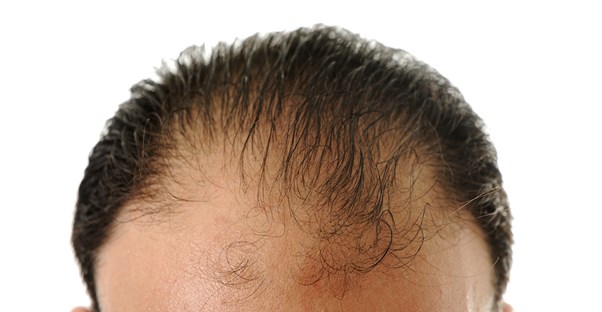 a man who is wondering what causes baldness