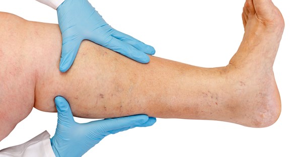a doctor diagnosing varicose veins