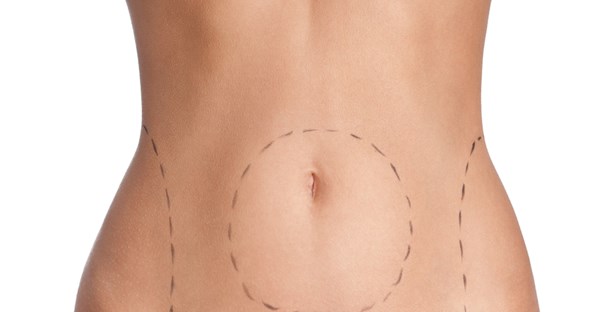 a woman about to undergo liposuction