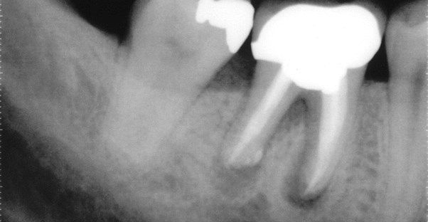 decaying teeth