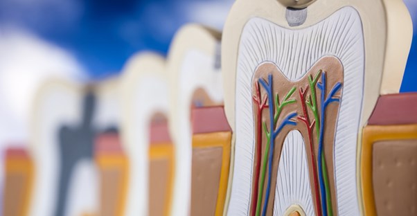 a diagram of a decaying tooth
