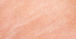 a picture of stretch marks
