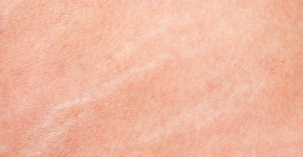 a picture of stretch marks