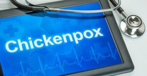 a doctor researching chickenpox