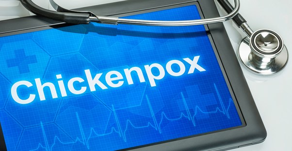 a doctor researching chickenpox