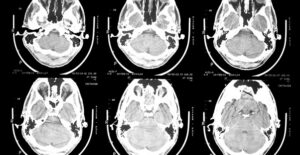 an image representing epilepsy