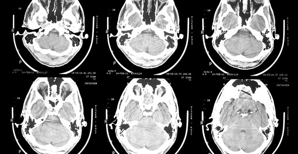an image representing epilepsy