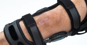 a knee that suffered an ACL injury