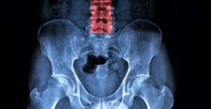a spine experiencing Ankylosing Spondylitis