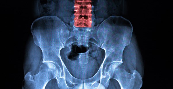 a spine experiencing Ankylosing Spondylitis