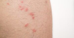 Clean your bedding if you have bed bugs