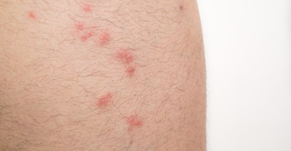 Clean your bedding if you have bed bugs