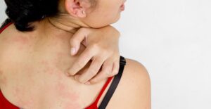 a woman living with rosacea