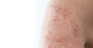 an arm that has rosacea