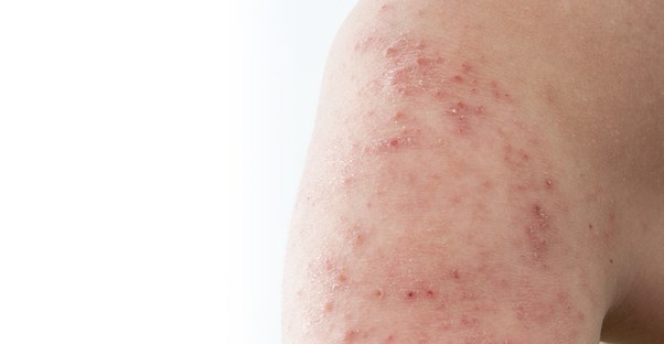 an arm that has rosacea