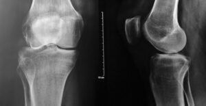 an image of the symptoms of multiple myeloma
