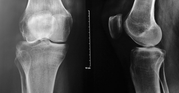 an image of the symptoms of multiple myeloma
