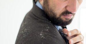 a man wondering what causes dandruff
