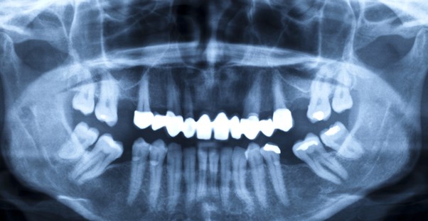 a person who needs dental implants