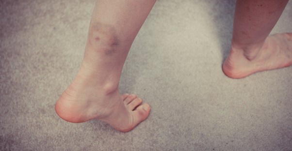 a bruise that is characteristic of hemophilia