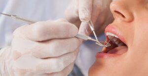 a dentist who has found dental caries in a patient's mouth