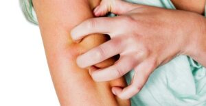 a woman suffering from atopic dermatitis