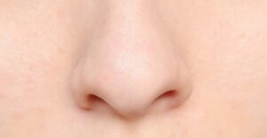 a woman suffering from blackheads