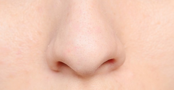 a woman suffering from blackheads