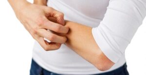 a woman experiencing plaque psoriasis symptoms