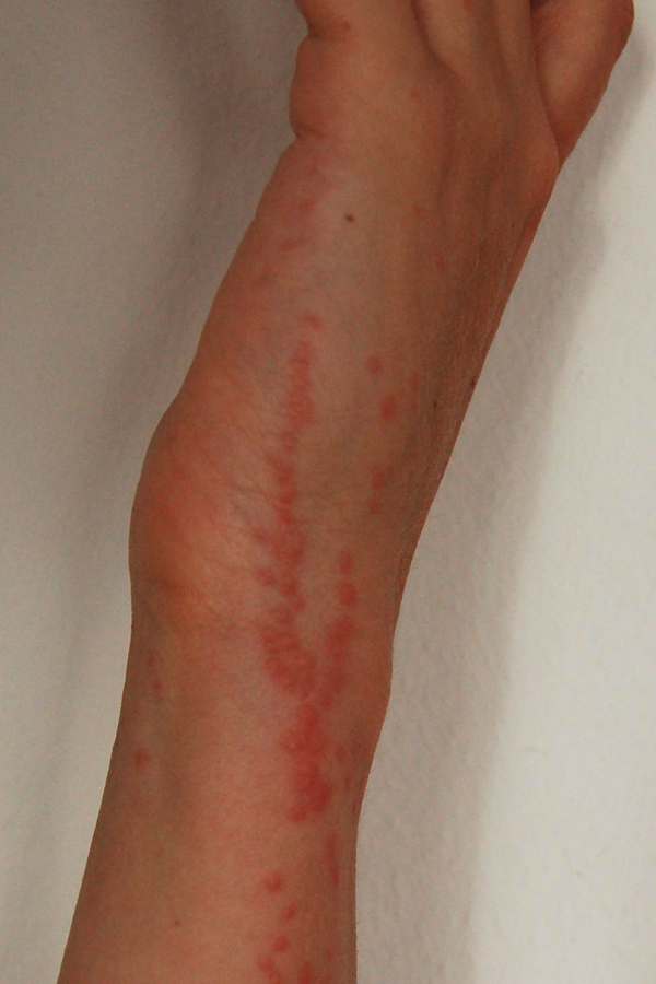 How are bed bug bites treated?