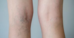 Spider veins that need treating