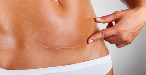 A woman understand her C-section scar.