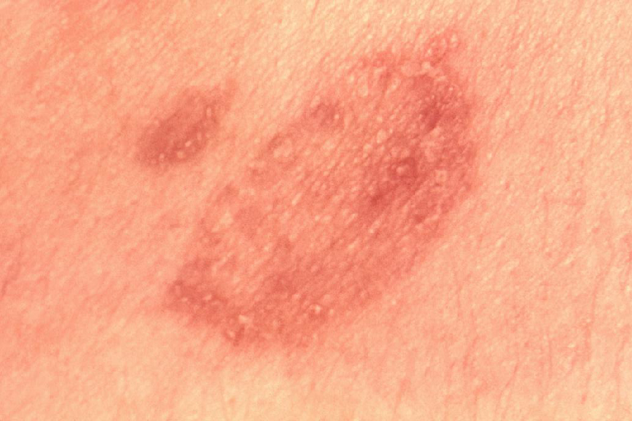 What are the symptoms of ringworm?