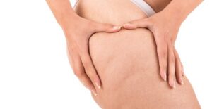 someone with cellulite