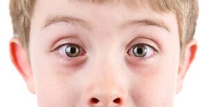 a boy suffering from pink eye