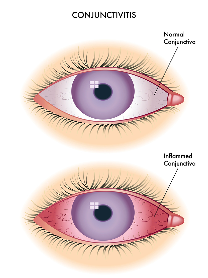 What Does Pink Eye Look Like?
