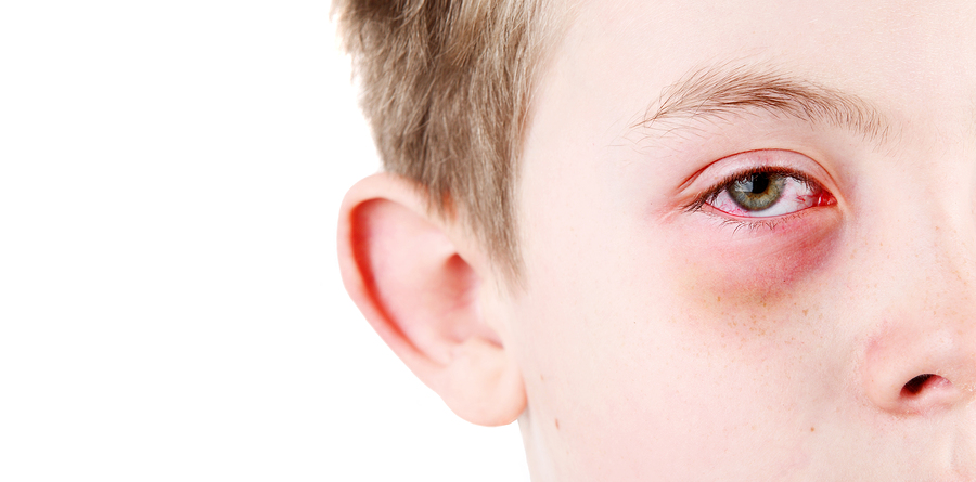 What is Pink Eye?