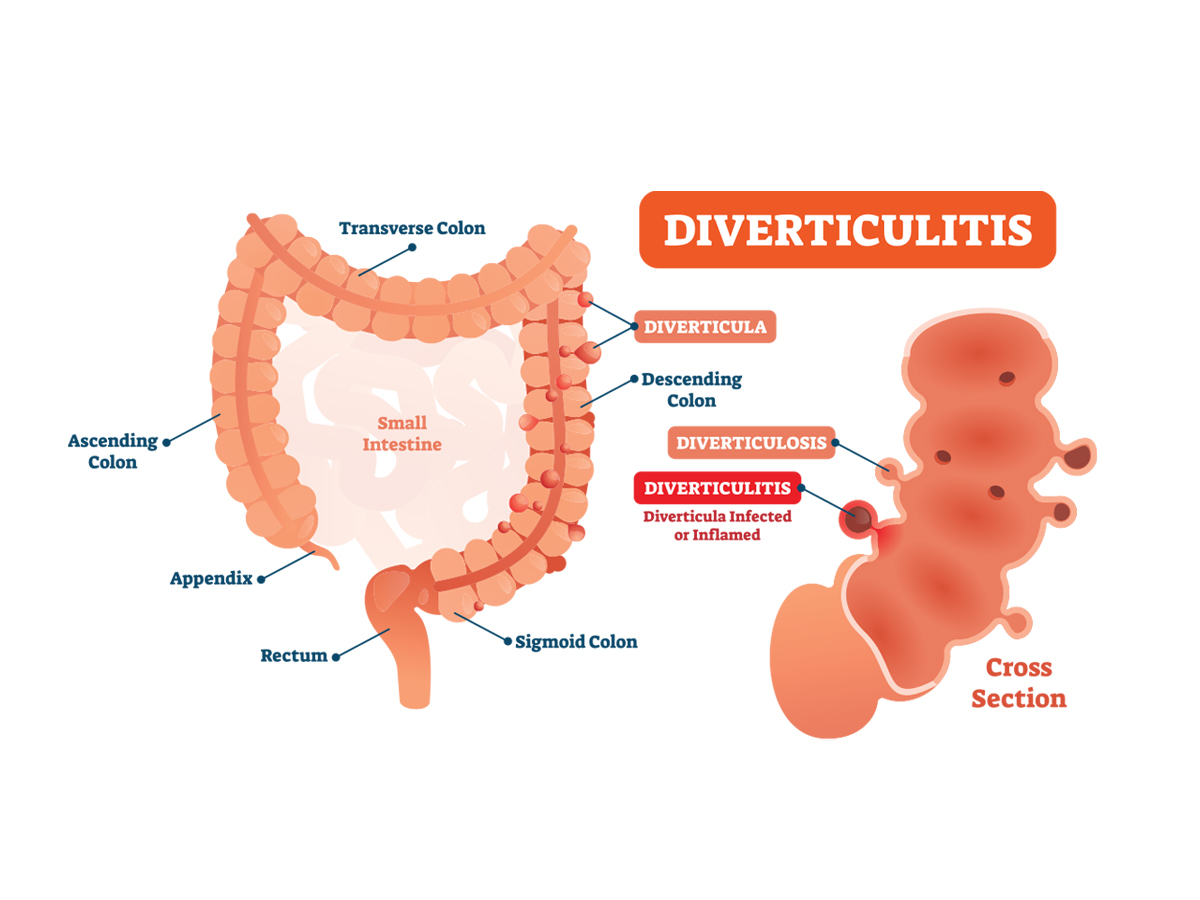 What is Diverticulitis?