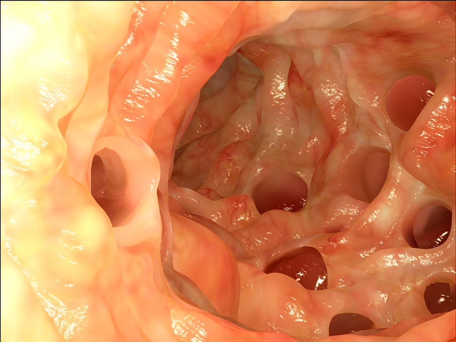 What is the Difference Between Diverticulitis and Diverticulosis?