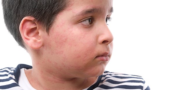 a boy with urticaria