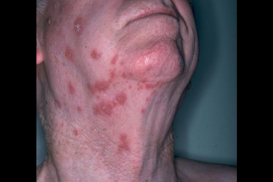 Shingles Symptoms